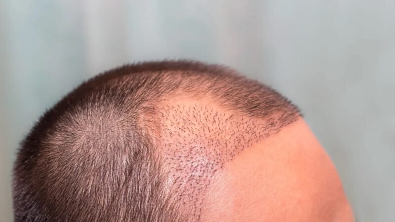 Reviving Confidence: Melbourne’s Leading Role in Hair Transplantation
